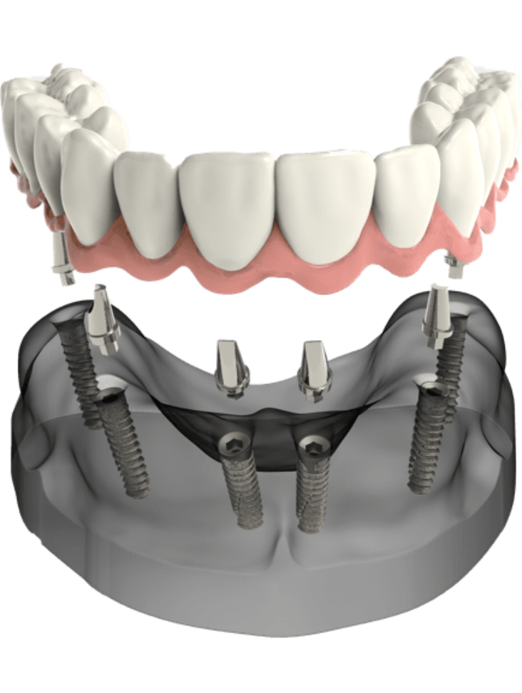 Implants - Like Natural Teeth