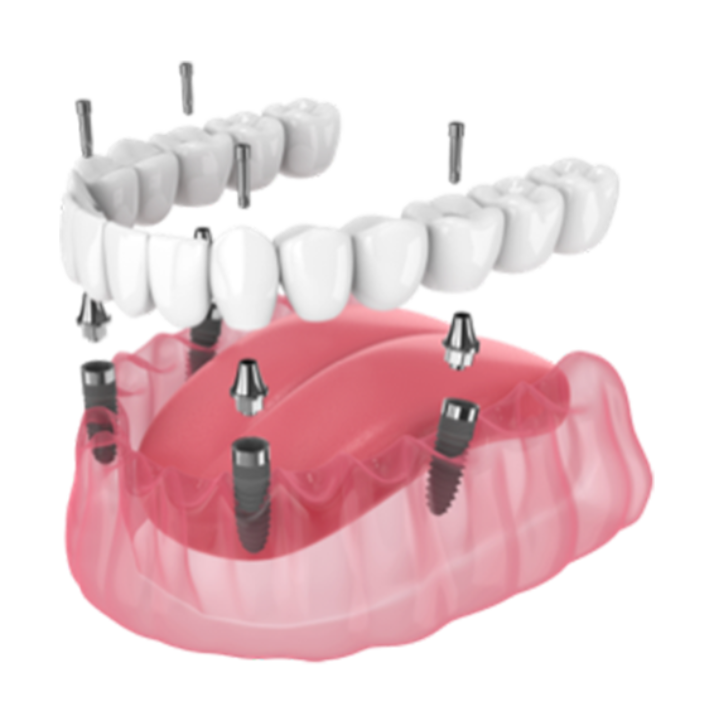 Implants - Short recovery time